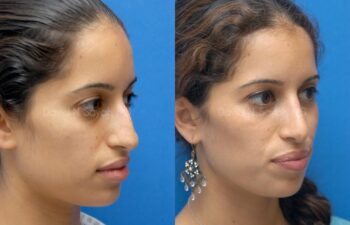 Rhinoplasty Before and After | Sayah Institute