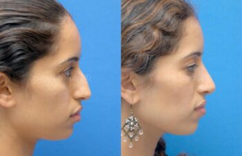 Rhinoplasty Before and After | Sayah Institute