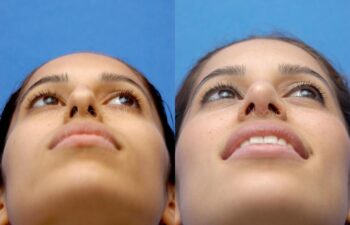 Rhinoplasty Before and After | Sayah Institute