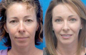 Facelift Before and After | Sayah Institute