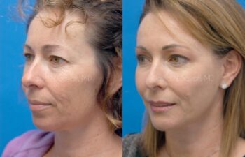 Facelift Before and After | Sayah Institute