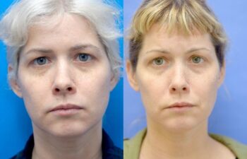 Eyelid Surgery Before and After | Sayah Institute