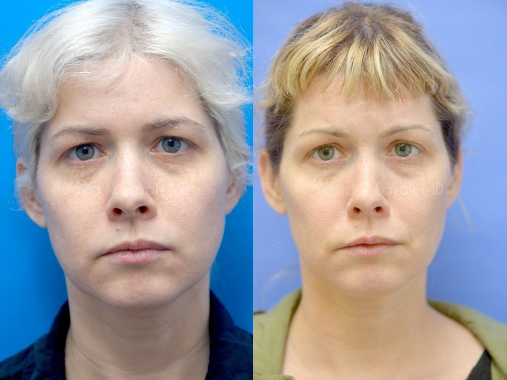 Eyelid Surgery Before and After | Sayah Institute