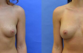 Breast Augmentation Before and After | Sayah Institute