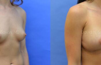 Breast Augmentation Before and After | Sayah Institute