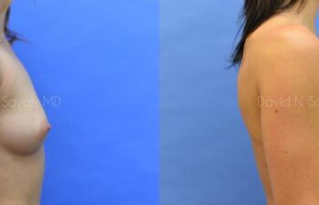 Breast Augmentation Before and After | Sayah Institute