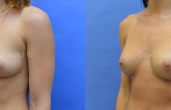 Breast Augmentation Before and After | Sayah Institute