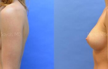 Breast Augmentation Before and After | Sayah Institute