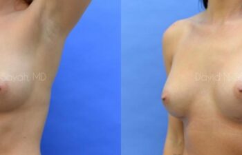 Breast Augmentation Before and After | Sayah Institute