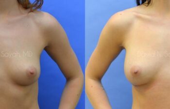 Breast Augmentation Before and After | Sayah Institute