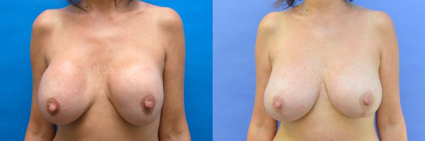 Breast Lift Before and After | Sayah Institute