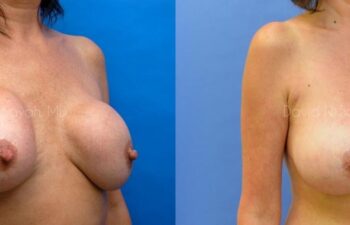 Breast Lift Before and After | Sayah Institute