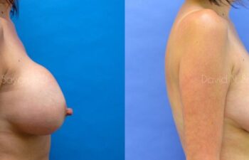 Breast Lift Before and After | Sayah Institute
