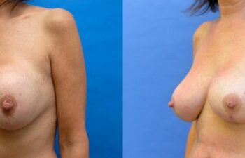 Breast Lift Before and After | Sayah Institute