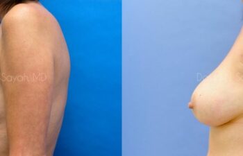 Breast Lift Before and After | Sayah Institute