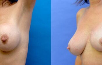 Breast Lift Before and After | Sayah Institute