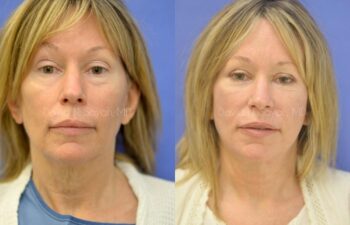 Facelift Before and After | Sayah Institute