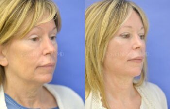 Facelift Before and After | Sayah Institute
