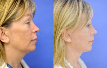 Facelift Before and After | Sayah Institute