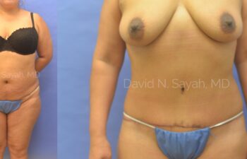 Tummy Tuck Before and After | Sayah Institute