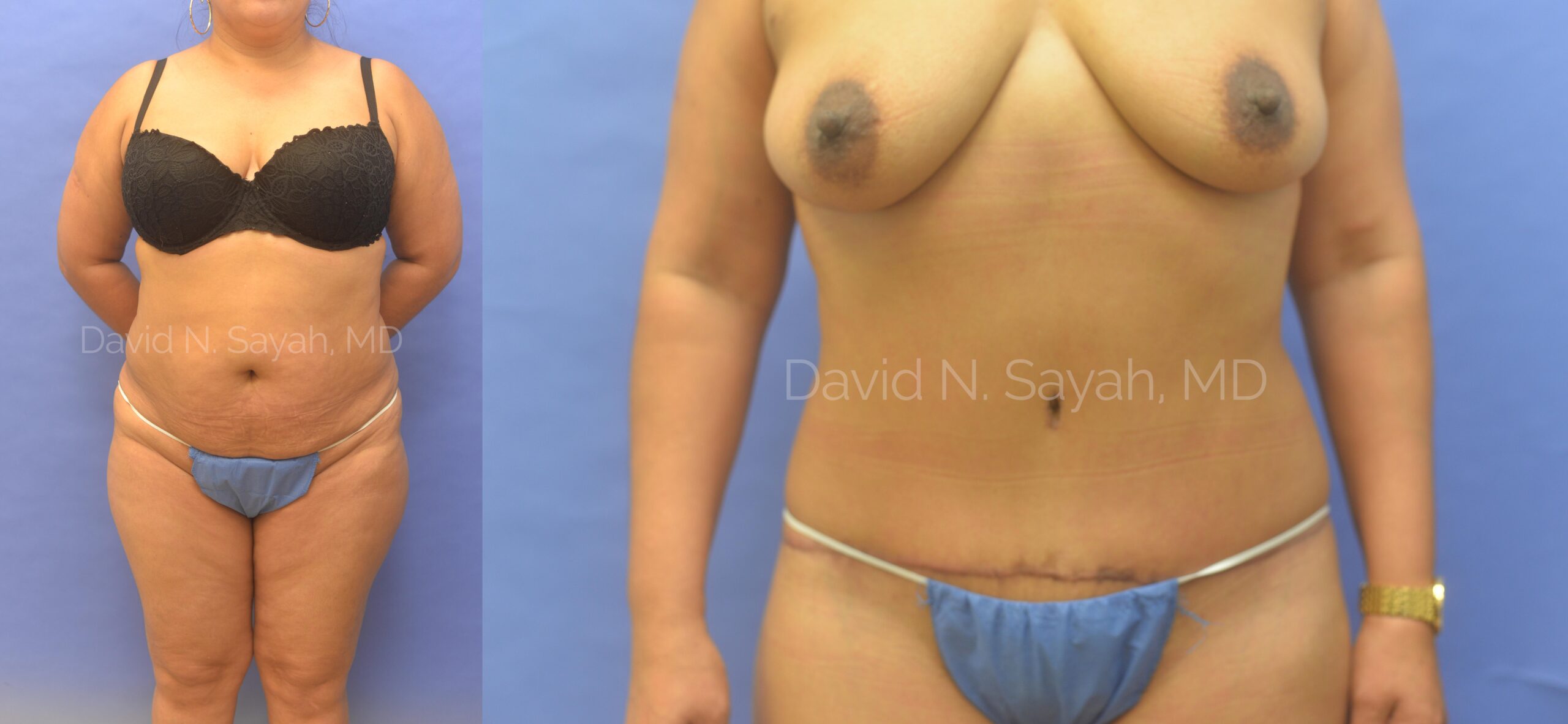 Tummy Tuck Before and After | Sayah Institute