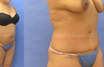 Tummy Tuck Before and After | Sayah Institute