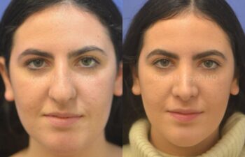 Rhinoplasty Before and After | Sayah Institute