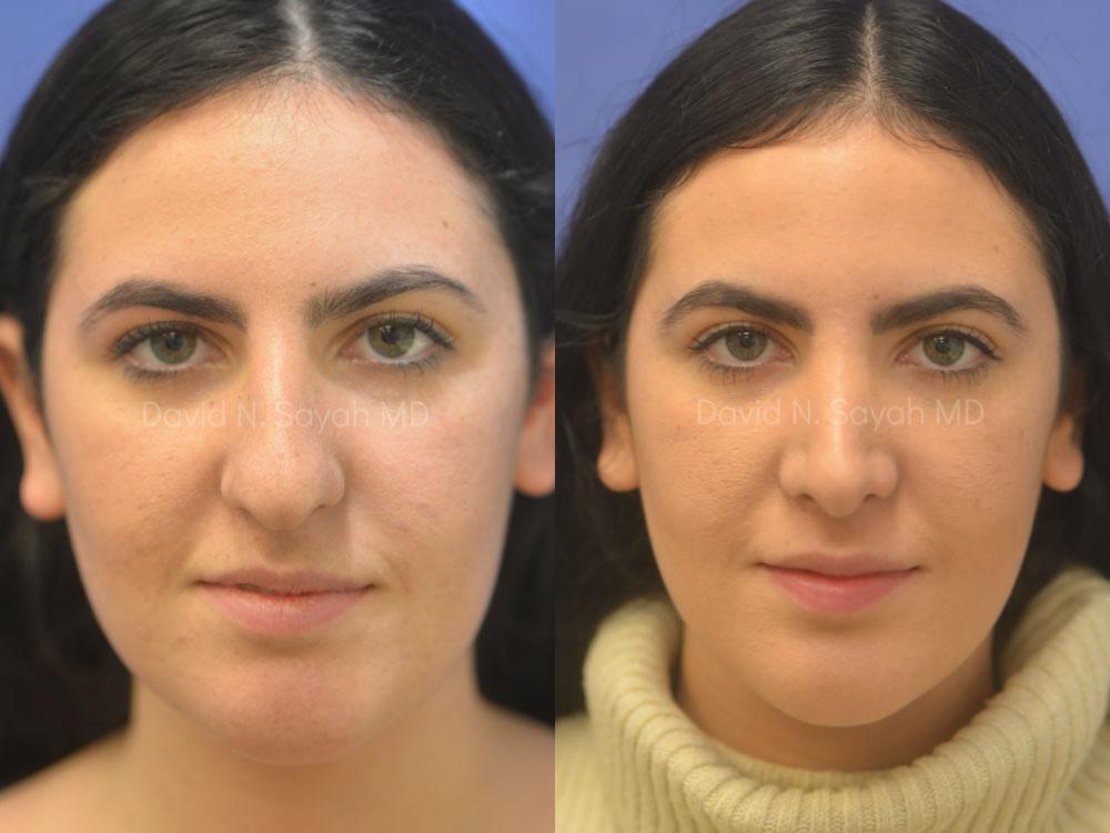 Rhinoplasty Before and After | Sayah Institute