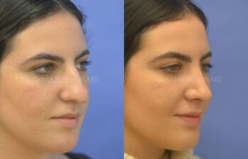 Rhinoplasty Before and After | Sayah Institute