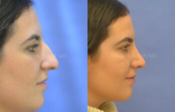 Rhinoplasty Before and After | Sayah Institute