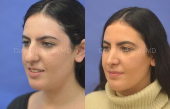Rhinoplasty Before and After | Sayah Institute