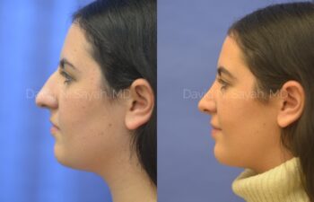 Rhinoplasty Before and After | Sayah Institute