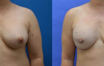 Breast Reconstruction Before and After | Sayah Institute