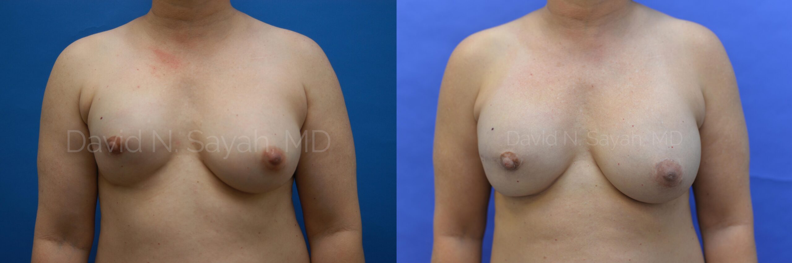 Breast Reconstruction Before and After | Sayah Institute