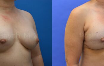 Breast Reconstruction Before and After | Sayah Institute