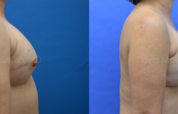 Breast Reconstruction Before and After | Sayah Institute