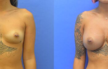 Breast Augmentation Before and After | Sayah Institute