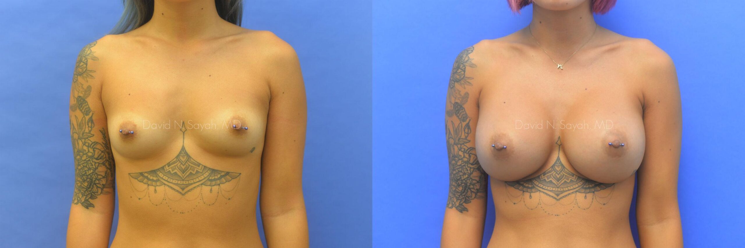 Breast Augmentation Before and After | Sayah Institute