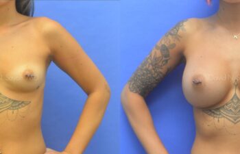 Breast Augmentation Before and After | Sayah Institute