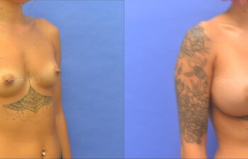 Breast Augmentation Before and After | Sayah Institute