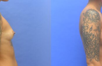 Breast Augmentation Before and After | Sayah Institute