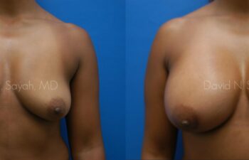 Breast Augmentation Before and After | Sayah Institute