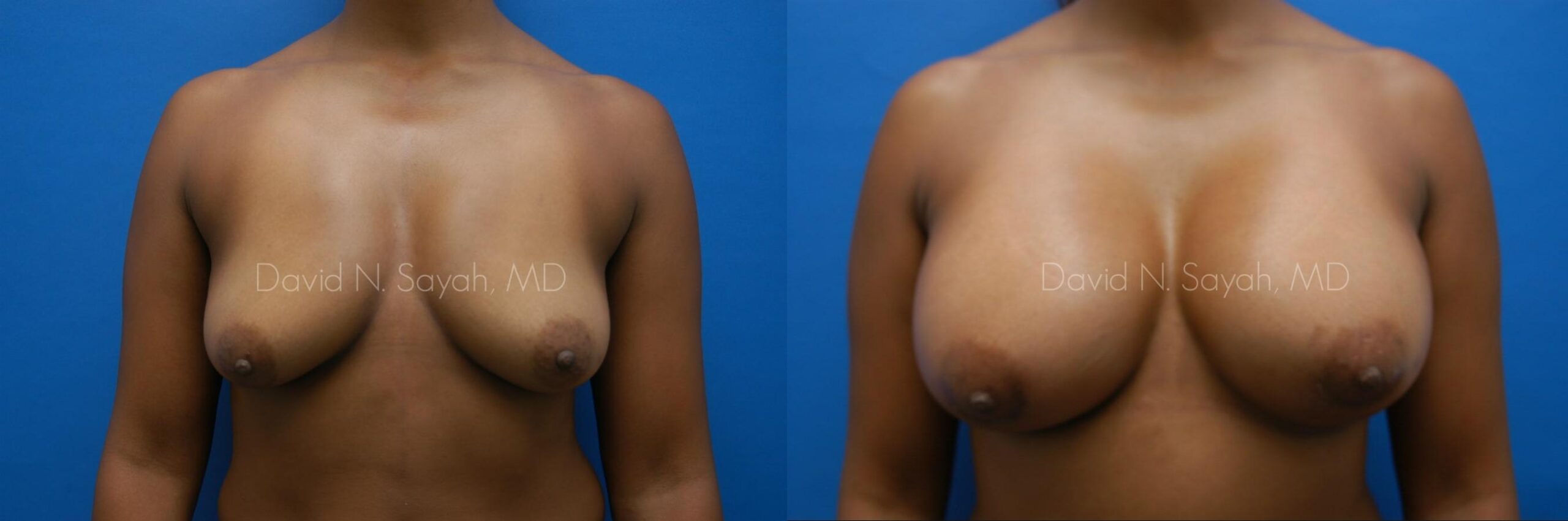 Breast Augmentation Before and After | Sayah Institute
