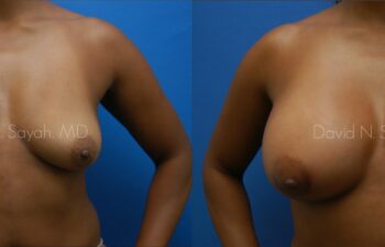 Breast Augmentation Before and After | Sayah Institute