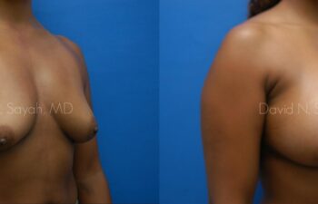 Breast Augmentation Before and After | Sayah Institute