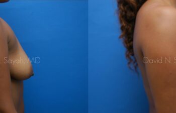 Breast Augmentation Before and After | Sayah Institute