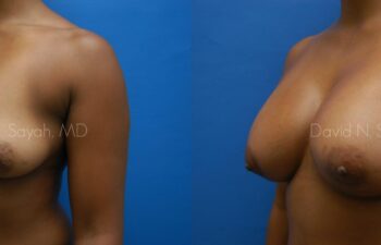 Breast Augmentation Before and After | Sayah Institute