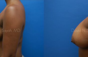 Breast Augmentation Before and After | Sayah Institute