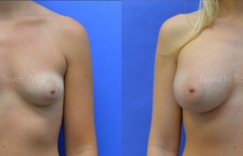 Breast Augmentation Before and After | Sayah Institute
