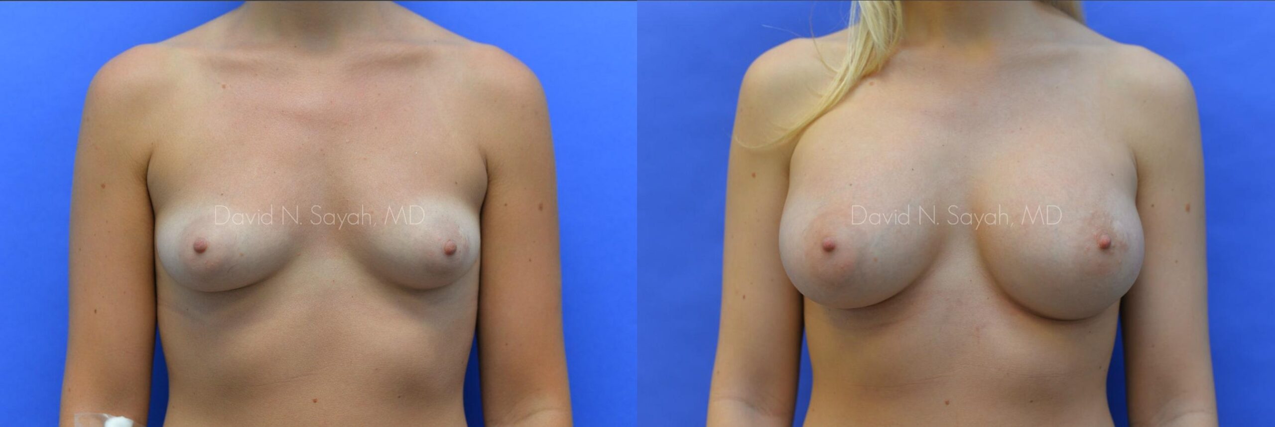 Breast Augmentation Before and After | Sayah Institute